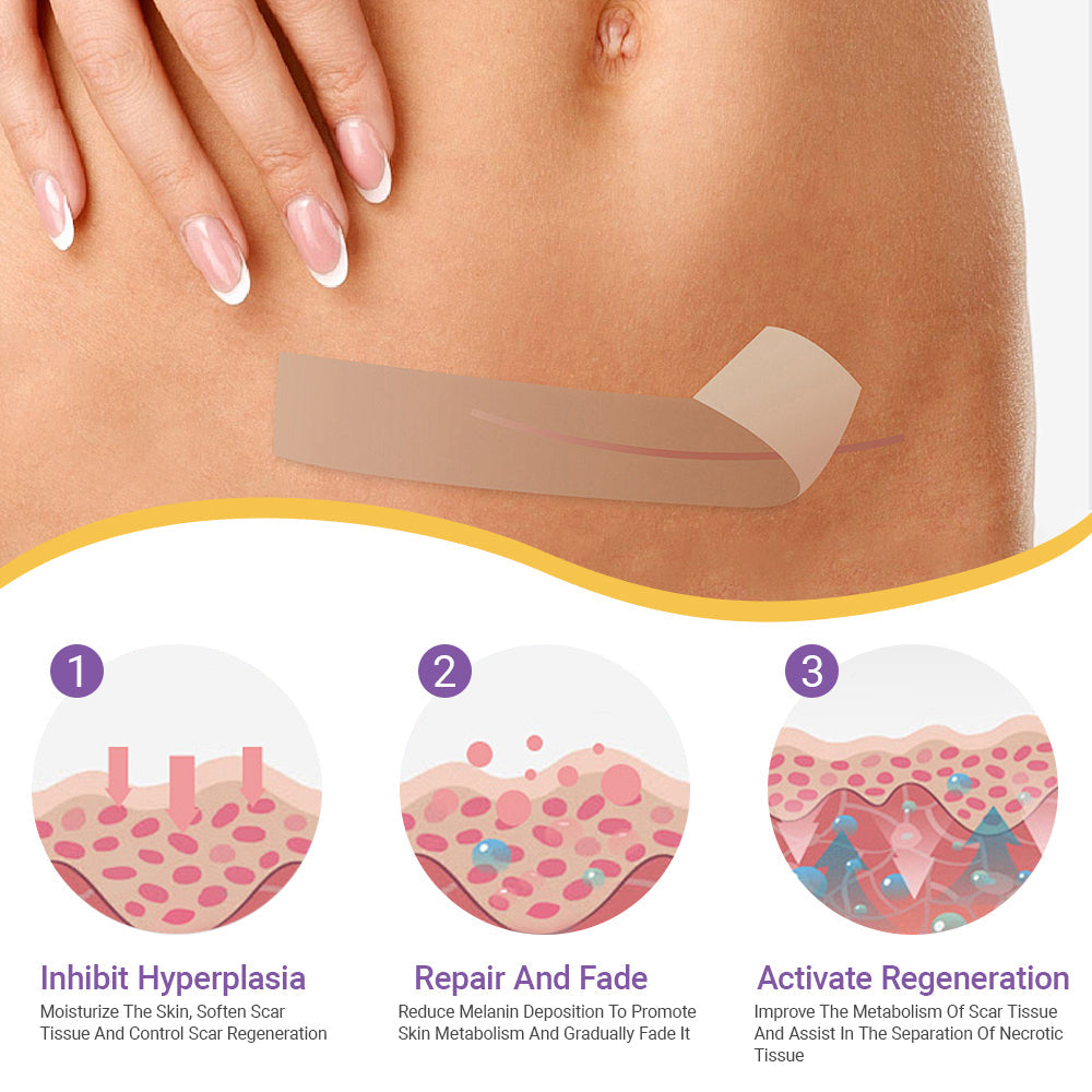 ✅Official Store |Ourlyard® Hyaluronic Acid Nano Microneedle Repair Tape🍁🏥(Treatment of old and new scars, reduction of surgical scars, stretch marks, keloids, acne, burns, warts, dermatomes and varicose veins)